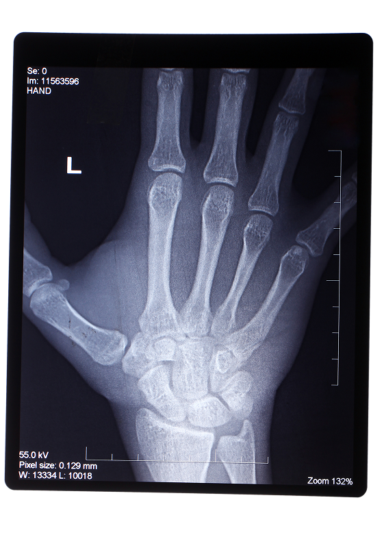 Basal Joint Arthritis Basal Joint Arthritis