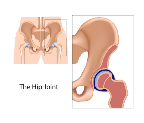 Hip Osteoarthritis
