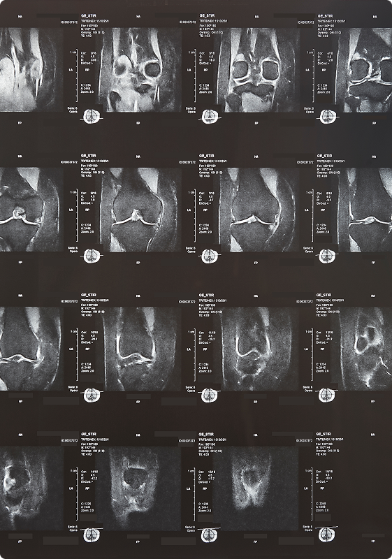 Patellar Instability