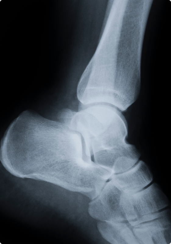 Plantar Fasciitis Plantar Fasciitis